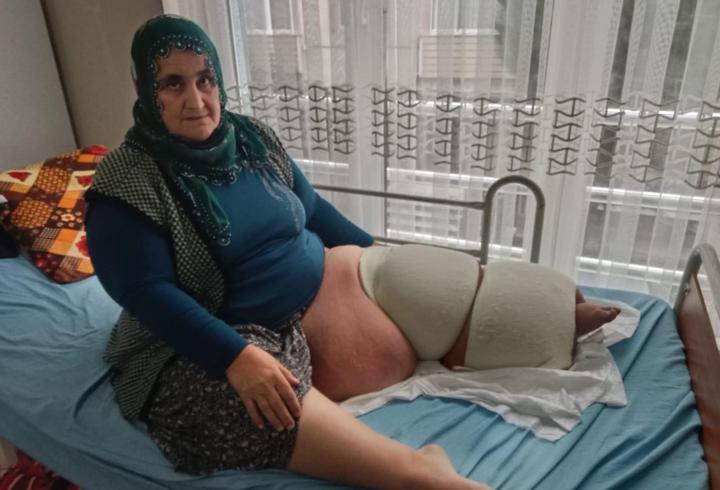 35 yıldır fil hastalığıyla mücadele ediyor
