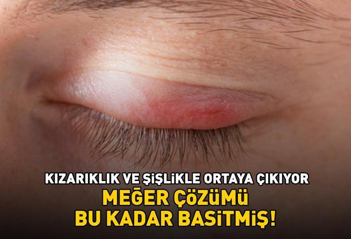 Göz kapağı iltihabına ne iyi gelir? Kızarıklık ve şişlikle ortaya çıkıyor! Meğer çözümü bu kadar basitmiş