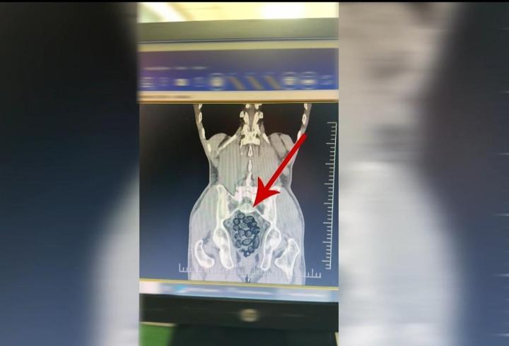 Yolcunun midesinden 472 gram metamfetamin çıktı