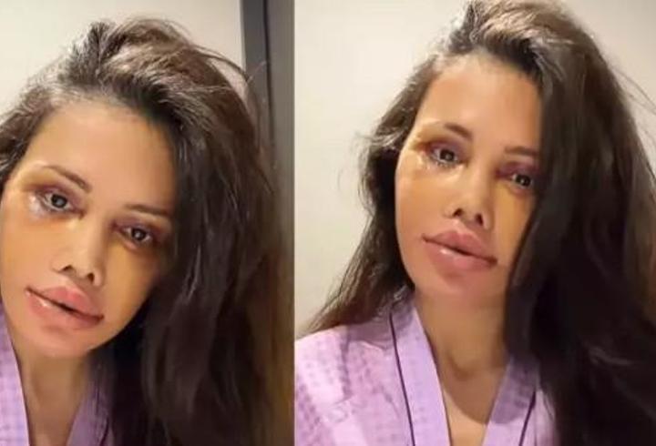 Didem Ceran’dan şaşırtan paylaşım! Yüz ameliyatı sonrası kaşında saç çıktı