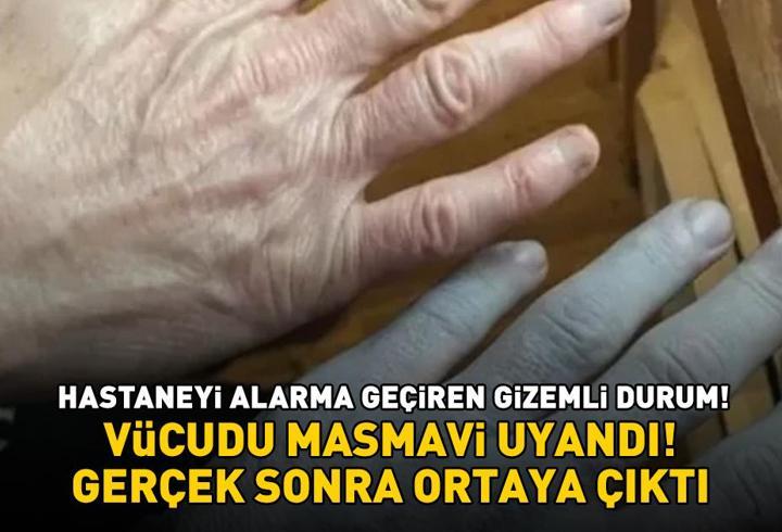 Hastaneyi alarma geçiren gizemli durum! Vücudu masmavi uyandı! Gerçek sonra ortaya çıktı