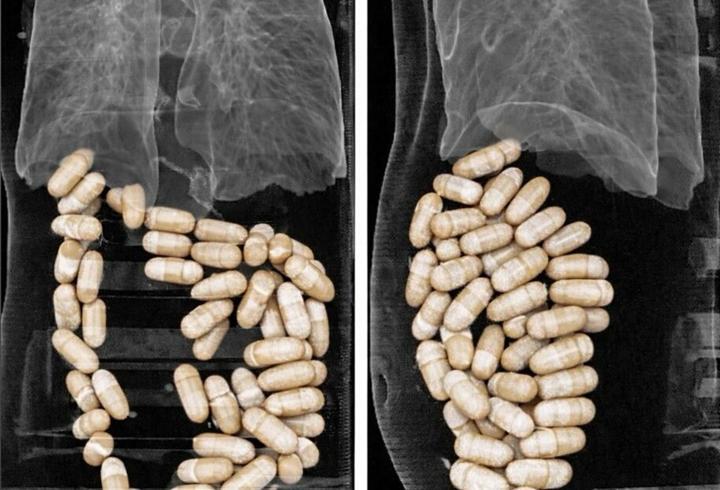 2 şüphelinin midesinden 127 kapsül uyuşturucu çıktı