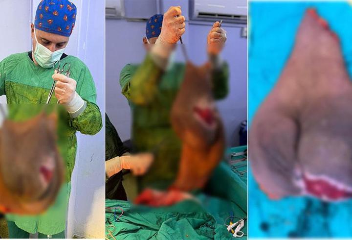 Hastanın karnından çıkarıldı: Tam 40 kilogram