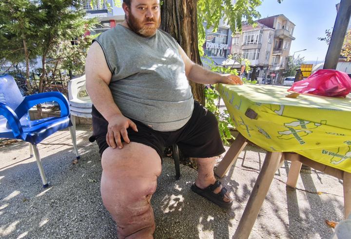 Fil hastası Kazım'ın tedavi olabilmesi için 82 kilo vermesi gerekiyor