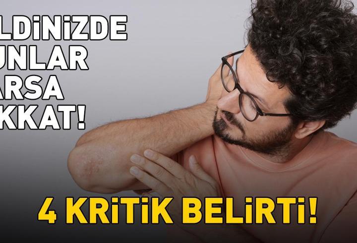 Sedef Hastalığını Ele Veren 4 Belirti! Cildinizdeki Değişimlere Dikkat