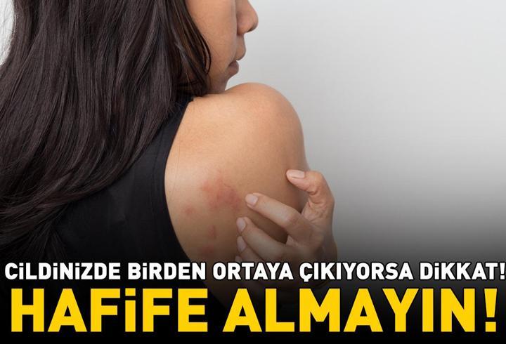 Cildinizde Birden Ortaya Çıkıyorsa Dikkat! Ürtikerin 5 Gizli Tetikleyicisi