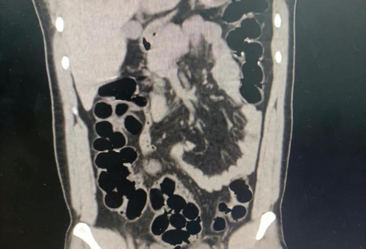 Midesinden Kapsüller İçinde 943 Gram Eroin Çıktı