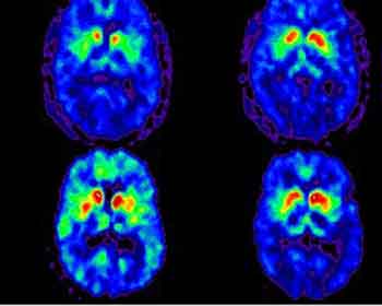 Parkinson sindirim sistemini de bozuyor