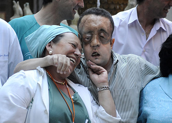 İşte ilk yüz nakli yapılan hasta