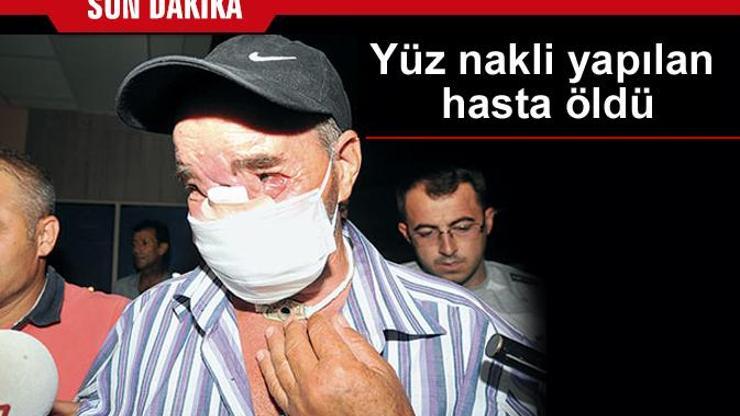 Yüz nakli yapılan hasta öldü