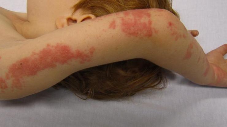 Lupus, tedavi edilmezse ölümcül olabilir