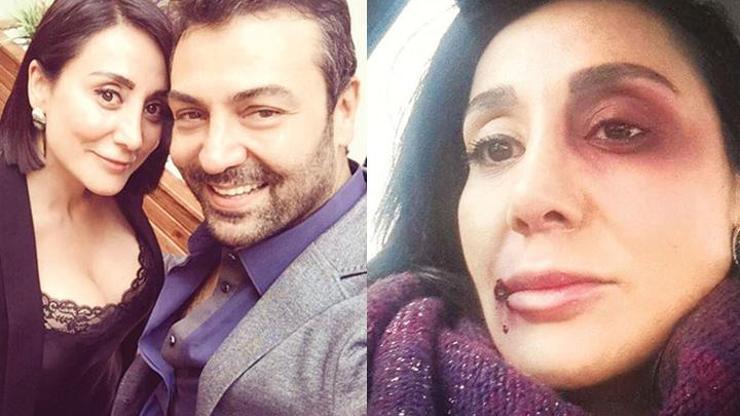 Saruhan Hünelin dövdüğü sevgilisi Edda Sönmeze koruma