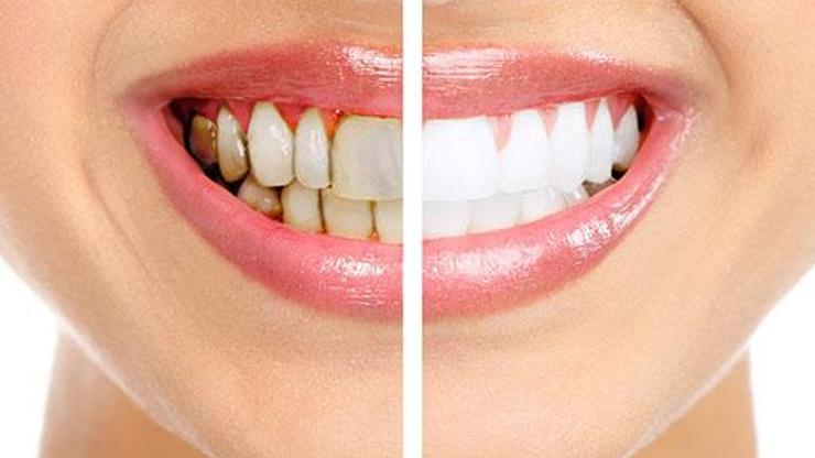 Diş sağlığı ile ilgili doğru bilinen 10 yanlış
