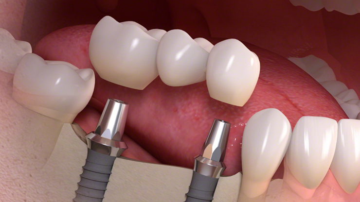 Sahte implant tehlike saçıyor