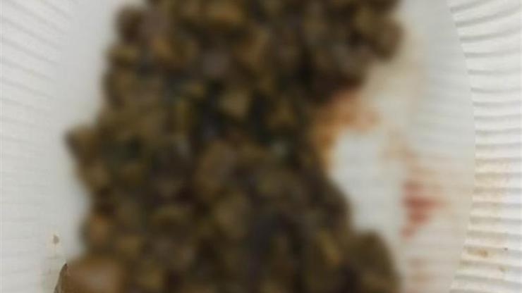 Karın ağrısıyla gitti, 100 adet taş çıktı