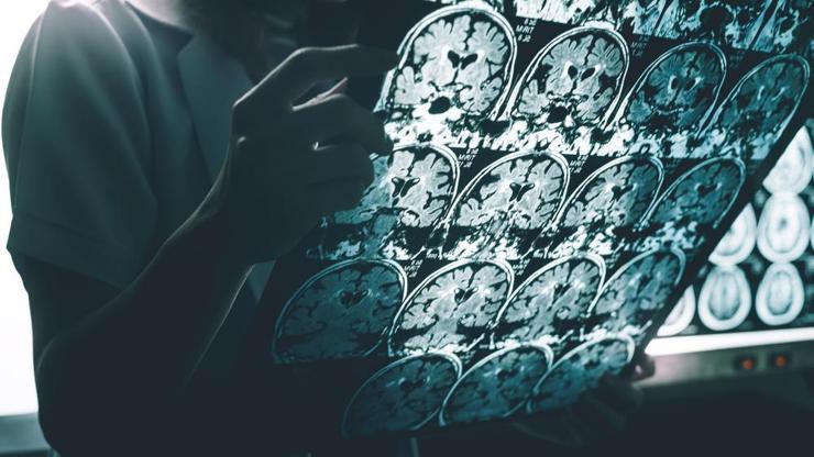 ABDli bilim insanlarından Alzheimer için büyük buluş