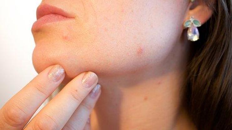 Akne tedavisinde peelingler etkili olabilir