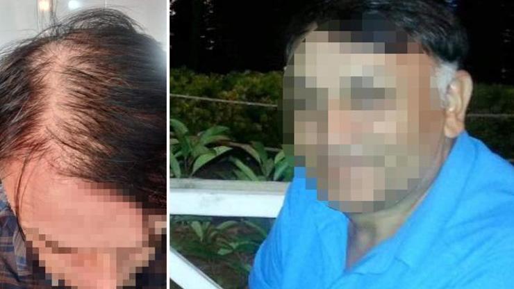 Saç ekiminden memnun kalmayan gıda mühendisi dava açtı