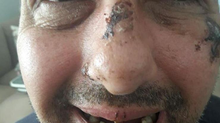 Sigara ve bisikletini vermeyince dişlerini döktüler