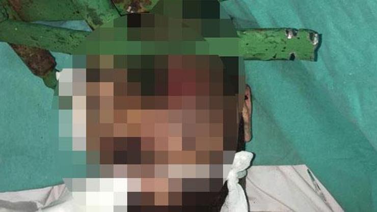 Korkunç olay Yüzüne demir çubuk saplandı