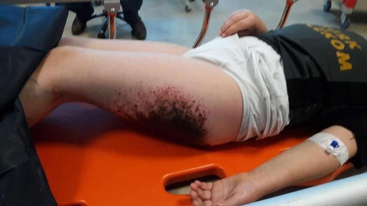 Yanık vakasında, numuneler Ankarada incelenecek