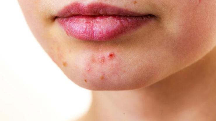 Tüm vücudu altüst eden hastalık: Lupus