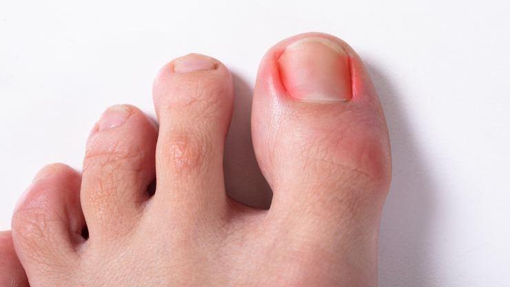 Tırnak batması hakkında sık sorulan sorular