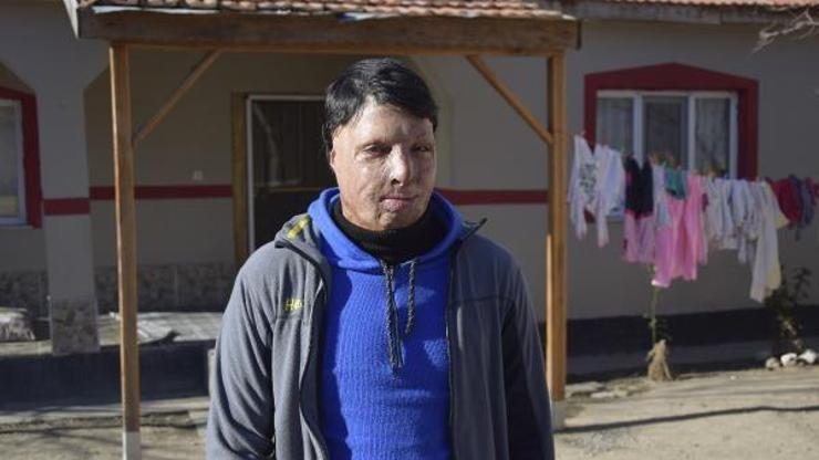 Yüzündeki yanık izleri nedeniyle evden çıkamayan Miraç, tedavi olmak istiyor