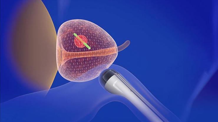 Prostat füzyon biyopsi nedir