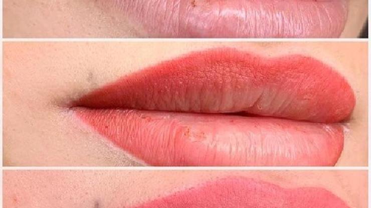 Dudakta oluşan pigment kaybı için öneriler