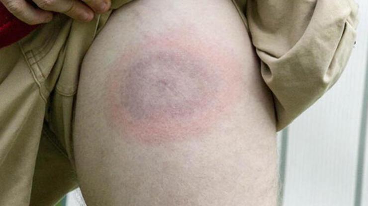 Lyme hastalığı tedavi sonrası yeniden ortaya çıkar mı