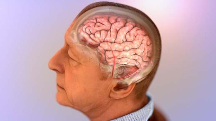 Alzheimer hastalığında glutatyon tedavisi