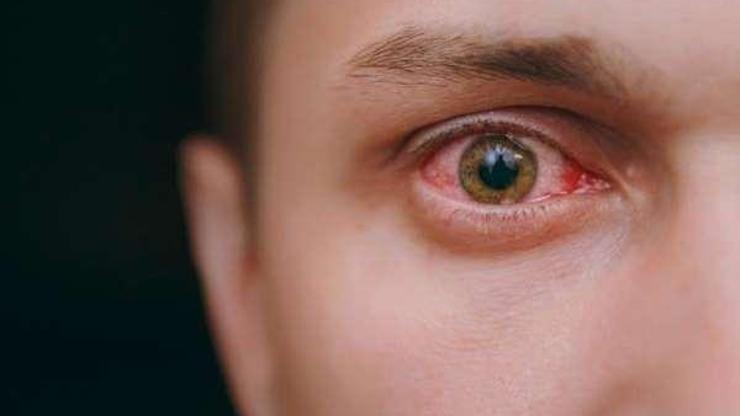 Adenovirüs nedir, belirtileri nelerdir Adenovirüslere bağlı kerato-konjonktivit nedir