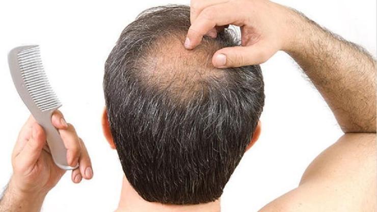 Erkeklerde saç dökülmesini durdurmak nasıl olur