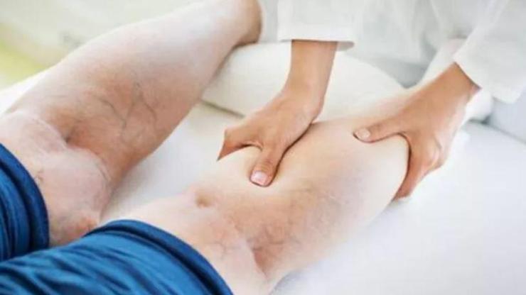 Varis oluşumunu önlemek için yapmanız gerekenler Varisten korunma yolları Varise iyi gelen öneriler