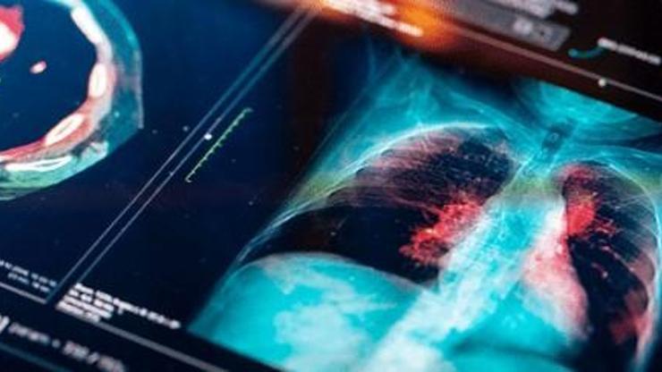 Akciğer kanserinin en sık görülen belirtisi: Hemoptizi