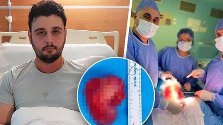 Kırık dişi hayatını kâbusa çevirdi: 29 yaşındaki gence dil kanseri şoku