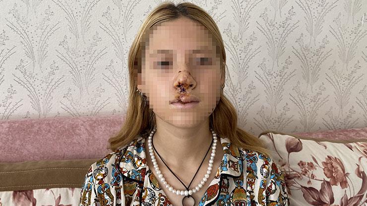 Türkiye’nin konuştuğu olayda genç kız anlattı: Hayatım karardı, yüzüm değişti