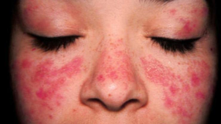Lupus nedir, ne demek Pozitif lupus hastalığı nedir Dilan Polatın hastalığı merak edildi