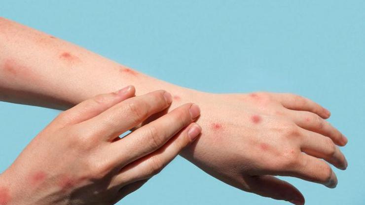 Pemfigus hastalığı nedir, neden olur Pemfigus hastalığı belirtileri neler, tedavisi var mı