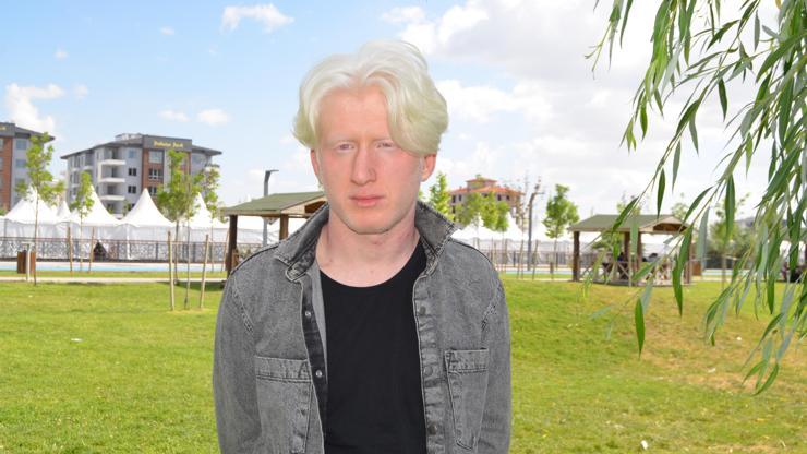 Albino hastası Emirhan: İnsanlar farklı yaklaşımlar sergileyebiliyor
