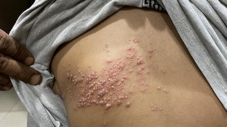 Zona virüsü nedir, belirtileri nelerdir Zona virüsü nasıl bulaşır, tedavisi nasıl yapılır