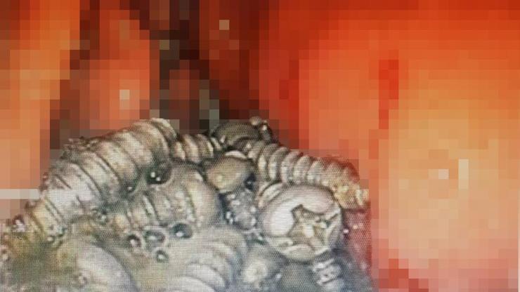 Duyan inanamadı 60 yaşındaki bir hastanın midesinden 47 tane cıvata çıktı