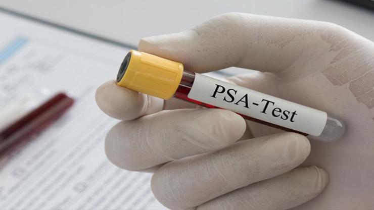 PSA Testi Nedir, Ne İşe Yarar Yüksekliği ve Düşüklüğü Ne Anlama Gelir