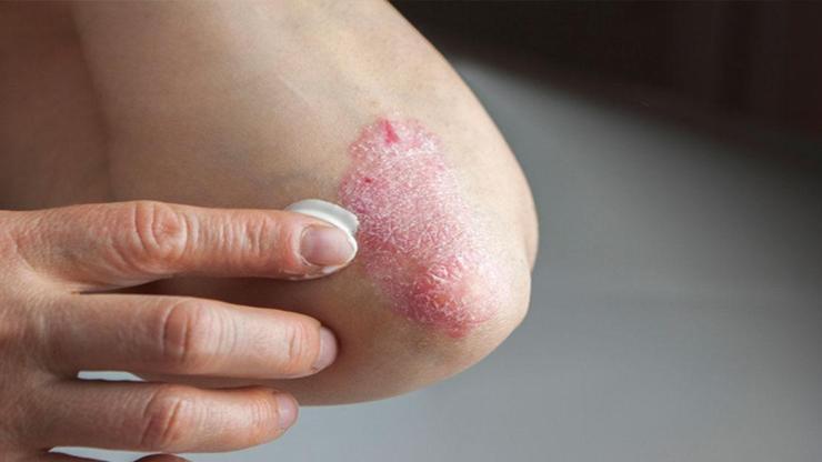 Sedef Hastalığı (Psoriasis) Nedir, Neden Olur Belirtileri ve Tedavi Yöntemleri Nelerdir