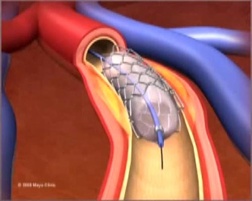 Kalp damarda eriyen stent dönemi