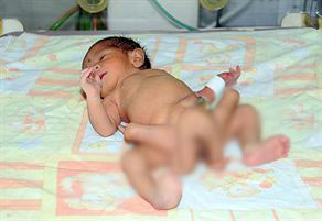 Pakistanda altı bacaklı bebek doğdu