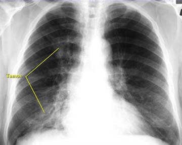 İleri evre akciğer kanseri için ilaç