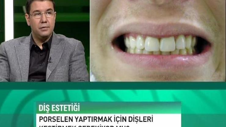 Porselen yaptırmak için dişleri kestirmek gerekir mi