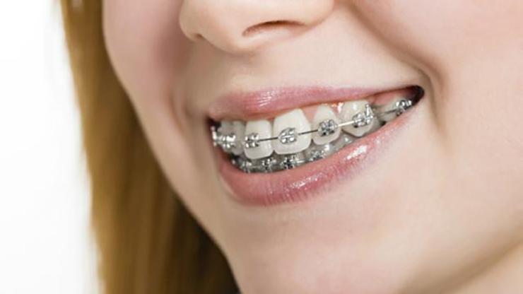 Erişkinler ortodontik tedavi görebilir mi